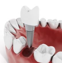 dental implants in new orleans, dentist in metairie