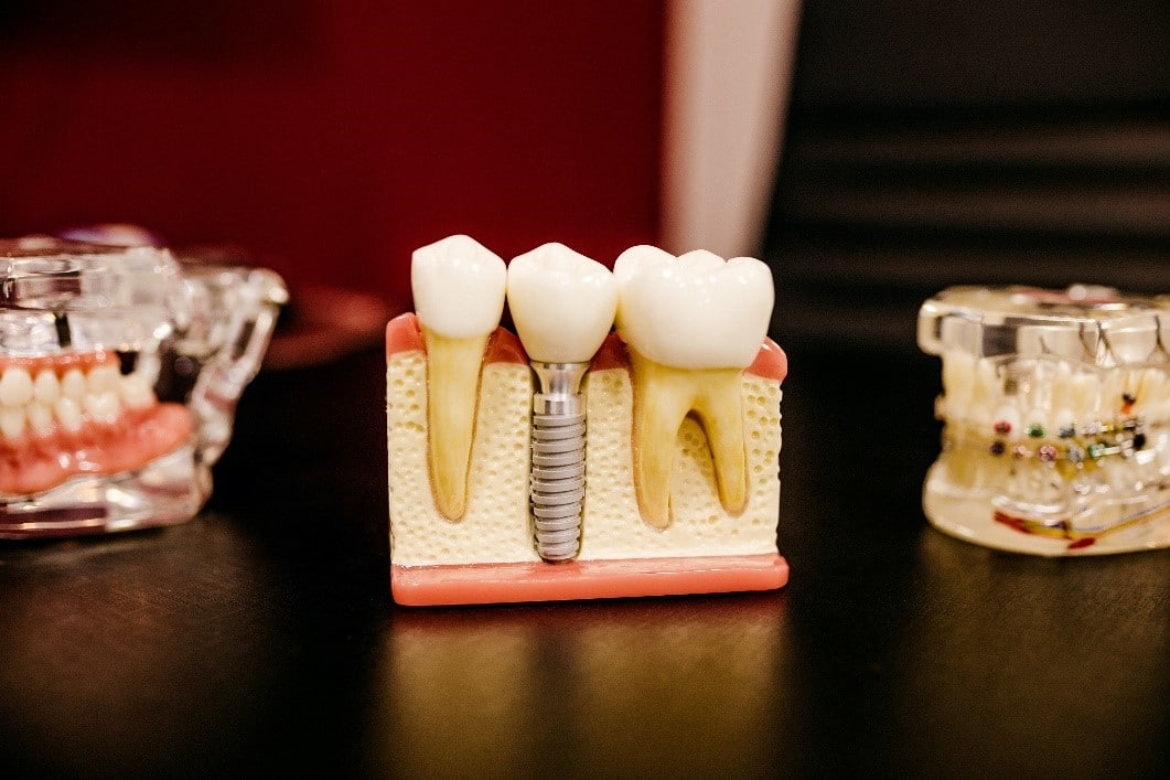 dental bridges