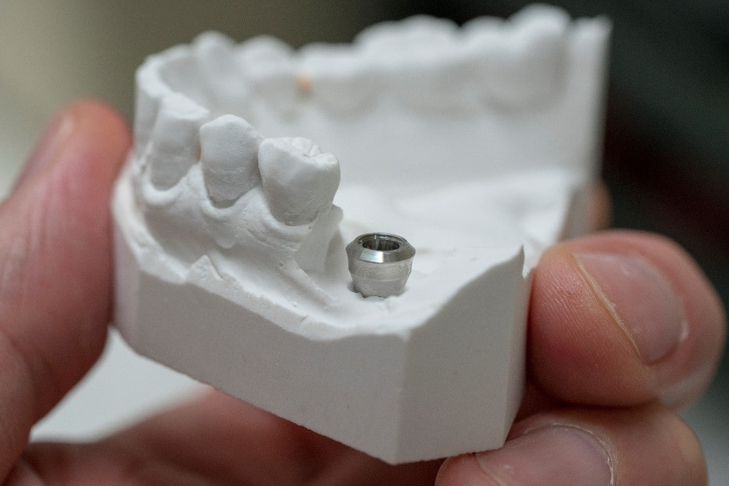 Are you wondering if it’s safe to get dental implants? Read this blog to learn more.
